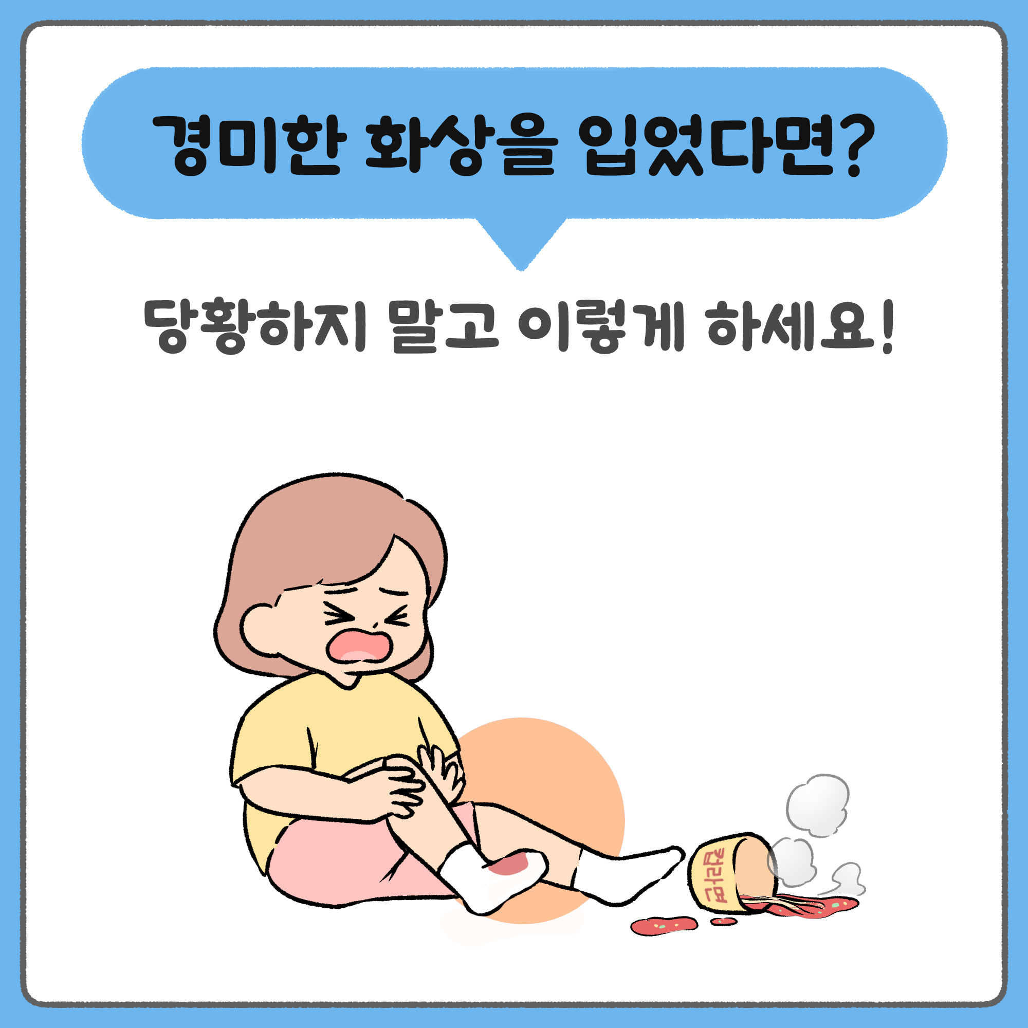 경미한 화상을 입었다면? 당황하지 말고 이렇게 하세요!